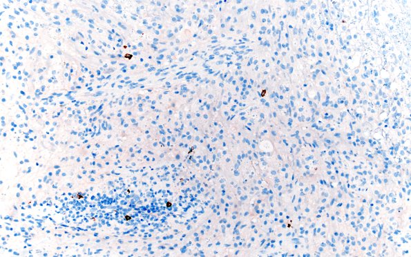 15G2 Inflamm Demyel (Case 15) CD20 20X