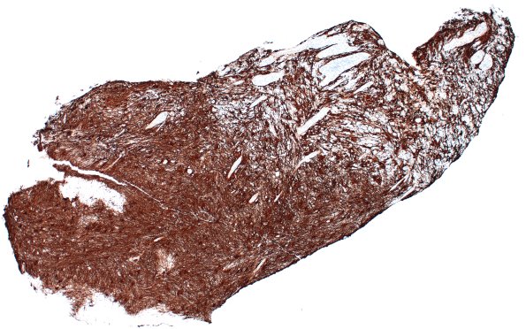 15H1 Inflamm Demyel (Case 15) GFAP 4X