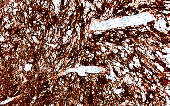 15H2 Inflamm Demyel (Case 15) GFAP 2X