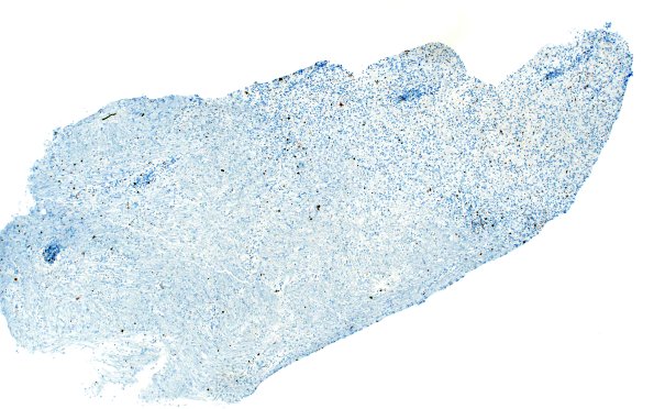 15I1 Inflamm Demyel (Case 15) Ki67 4X