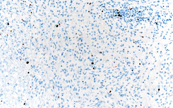 15I2 Inflamm Demyel (Case 15) Ki67 20X