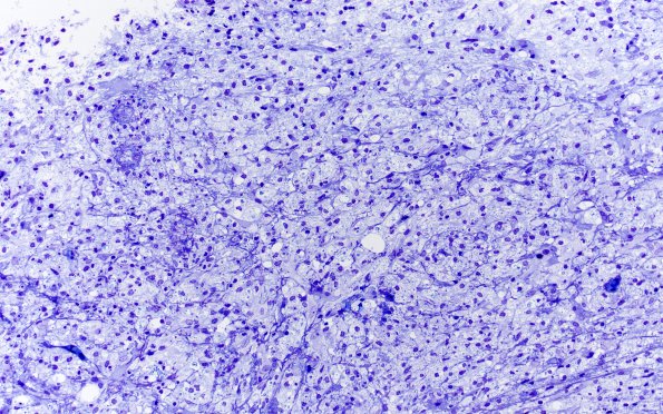 15J1 Inflamm Demyel (Case 15) Plastic 20X 1