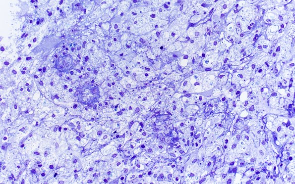 15J2 Inflamm Demyel (Case 15) Plastic 40X 3