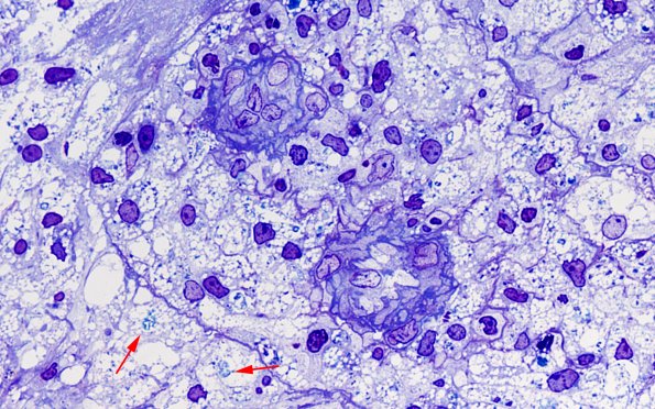 15J3 Inflamm Demyel (Case 15) Plastic 100X 1 copy