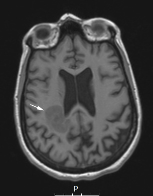 16A1 Inflammatory Demyelination (Case 16) T1 NoC copy