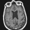 16A2 Inflammatory Demyelination (Case 16) T1W - Copy