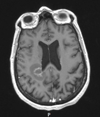 16A2 Inflammatory Demyelination (Case 16) T1W - Copy