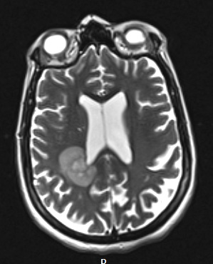 16A3 Inflammatory Demyelination (Case 16) T2W - Copy