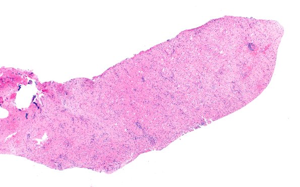 16B1 Inflammatory Demyelination (Case 16) H&E 4X