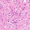 16B4 Inflammatory Demyelination (Case 16) H&E 40X