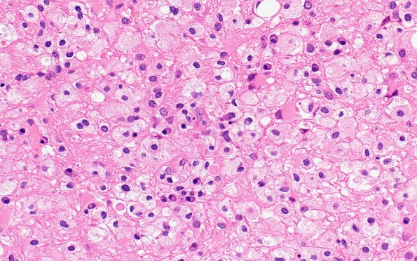 16B4 Inflammatory Demyelination (Case 16) H&E 40X