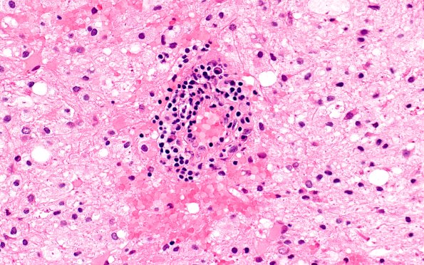 16B5 Inflammatory Demyelination (Case 16) H&E 40X 2
