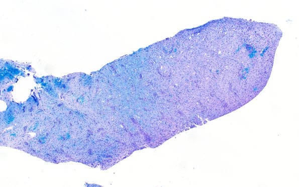 16C1 Inflammatory Demyelination (Case 16) LFB-PAS 4X 1
