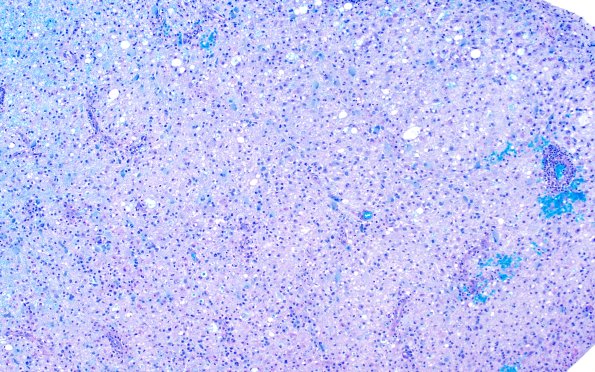 16C2 Inflammatory Demyelination (Case 16) LFB-PAS 10X 1