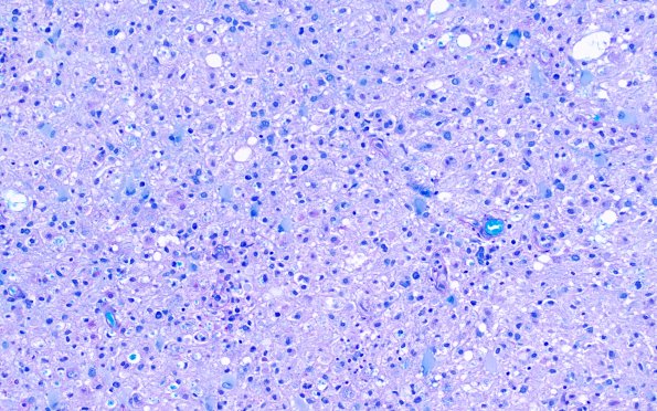 16C3 Inflammatory Demyelination (Case 16) LFB-PAS 20X 1