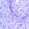 16C4 Inflammatory Demyelination (Case 16) LFB-PAS 40X 1