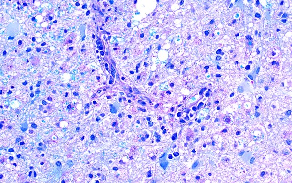 16C4 Inflammatory Demyelination (Case 16) LFB-PAS 40X 1