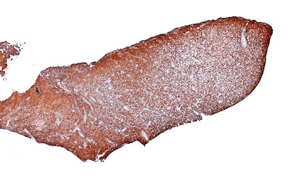 16D1 Inflammatory Demyelination (Case 16) NF 4X 1