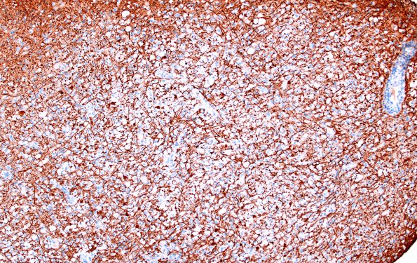 16D2 Inflammatory Demyelination (Case 16) NF 10X 1A
