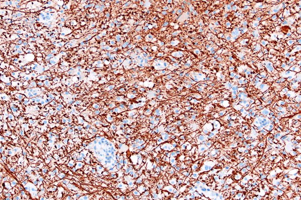 16D3 Inflammatory Demyelination (Case 16) NF 20X 1