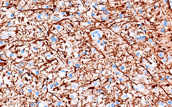 16D4 Inflammatory Demyelination (Case 16) NF 40X 3