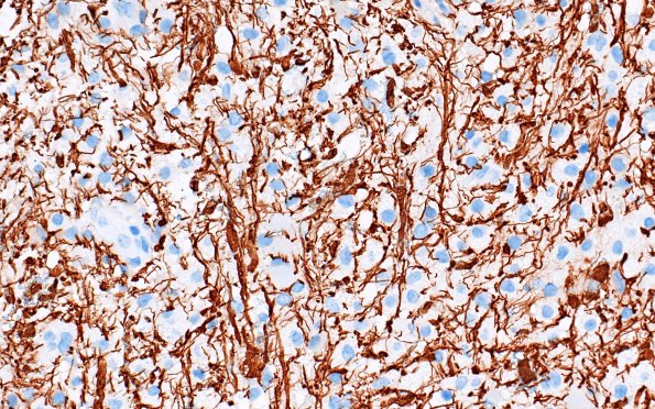 16D5 Inflammatory Demyelination (Case 16) NF 40X 2