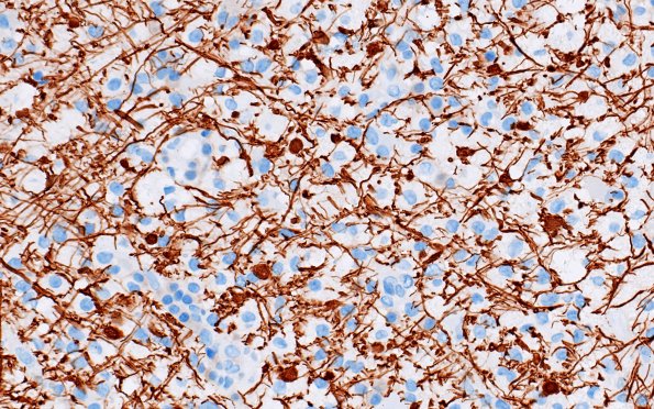 16D6 Inflammatory Demyelination (Case 16) NF 40X 1