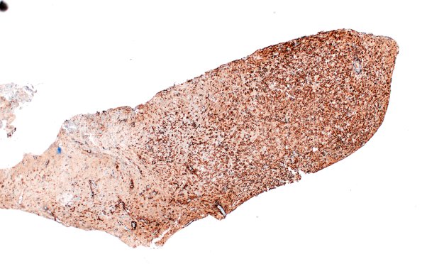 16E1 Inflammatory Demyelination (Case 16) CD163 4X 1