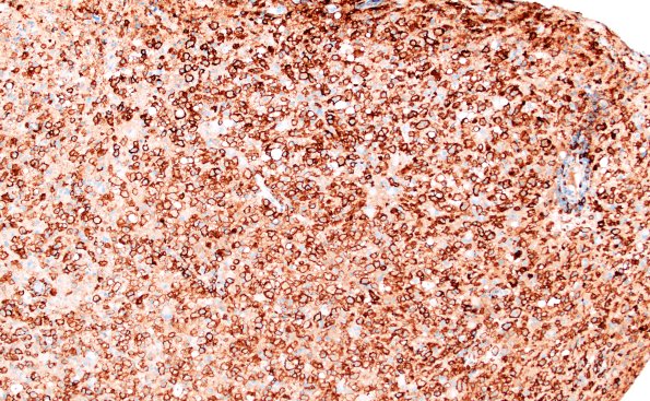 16E2 Inflammatory Demyelination (Case 16) CD163 10X 1A