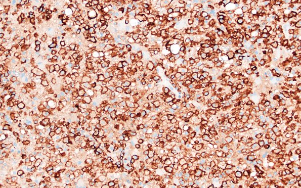 16E3 Inflammatory Demyelination (Case 16) CD163 20X 1