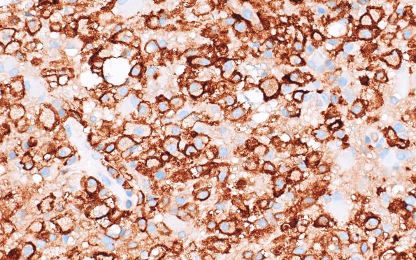16E4 Inflammatory Demyelination (Case 16) CD163 40X 1