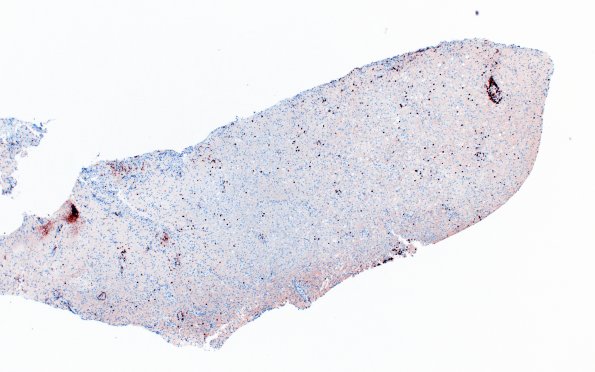 16F1 Inflammatory Demyelination (Case 16) CD3 4X 1