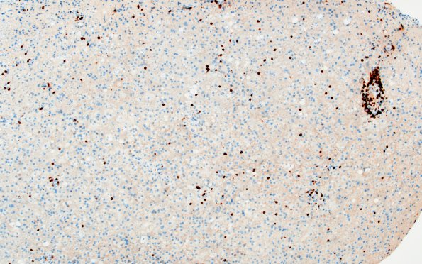 16F2 Inflammatory Demyelination (Case 16) CD3 10X 1