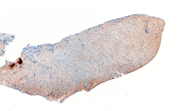 16G1 Inflammatory Demyelination (Case 16) CD20 4X 1