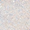 16G2 Inflammatory Demyelination (Case 16) CD20 20X 1