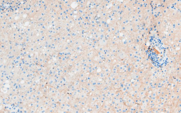 16G2 Inflammatory Demyelination (Case 16) CD20 20X 1