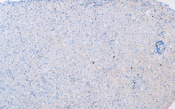 16I1 Inflammatory Demyelination (Case 16) Ki67 10X 3