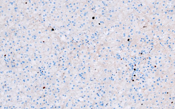 16I2 Inflammatory Demyelination (Case 16) Ki67 20X 3