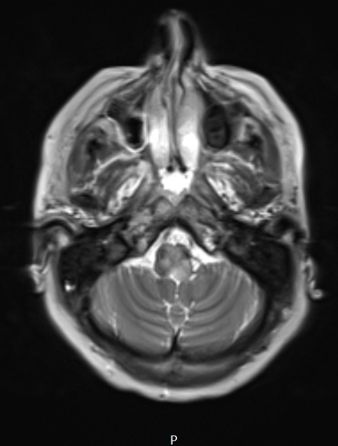 17A1 Demyelination, inflammatory (Case 17) T2 1 - Copy