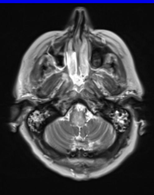 17A2 Demyelination, inflammatory (Case 17) T2 2 - Copy