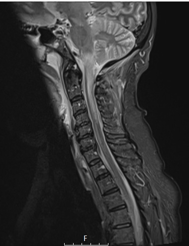 17A3 Demyelination, inflammatory (Case 17) STIR CSP NoC - Copy