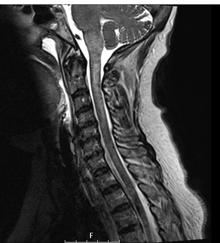 17A4 Demyelination, inflammatory (Case 17) T2 - Copy