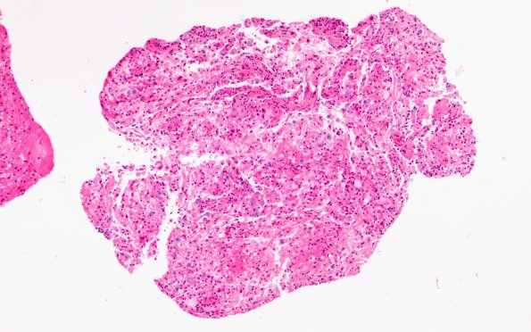 17B1 Demyelination, inflammatory (Case 17) H&E 10X
