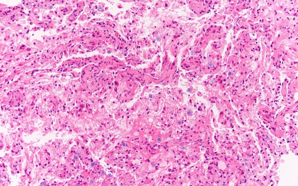 17B2 Demyelination, inflammatory (Case 17) H&E 20X