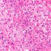17B3 Demyelination, inflammatory (Case 17) H&E 40X 2