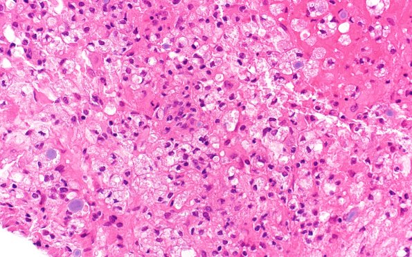 17B3 Demyelination, inflammatory (Case 17) H&E 40X 2