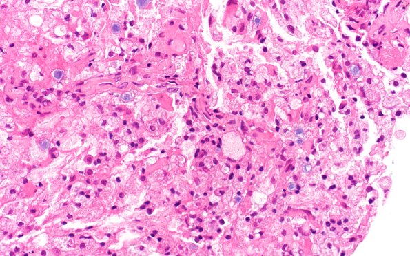 17B4 Demyelination, inflammatory (Case 17) H&E 40X