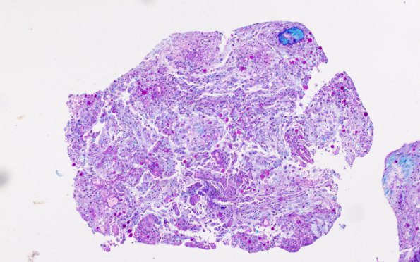 17C1 Demyelination, inflammatory (Case 17) LFB-PAS 10X 1