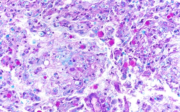 17C3 Demyelination, inflammatory (Case 17) LFB-PAS 40X 1
