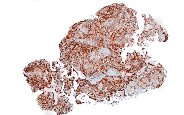 17D1 Demyelination, inflammatory (Case 17) NF 10X 1